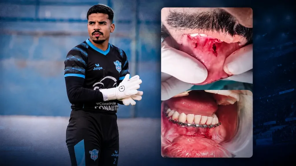 Felipe Nicolas sofreu fratura na mandíbula durante a partida contra o Bandeirante e ficará afastado das atividades esportivas. (Foto: Matheus Dahsan)